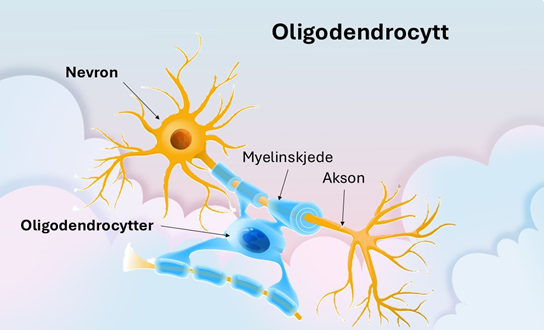 Oligodendrogliom grad 2 (lavgradig)